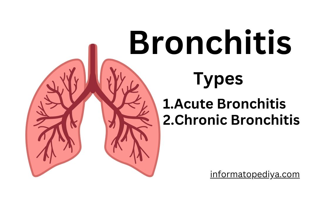 bronchitis symptoms