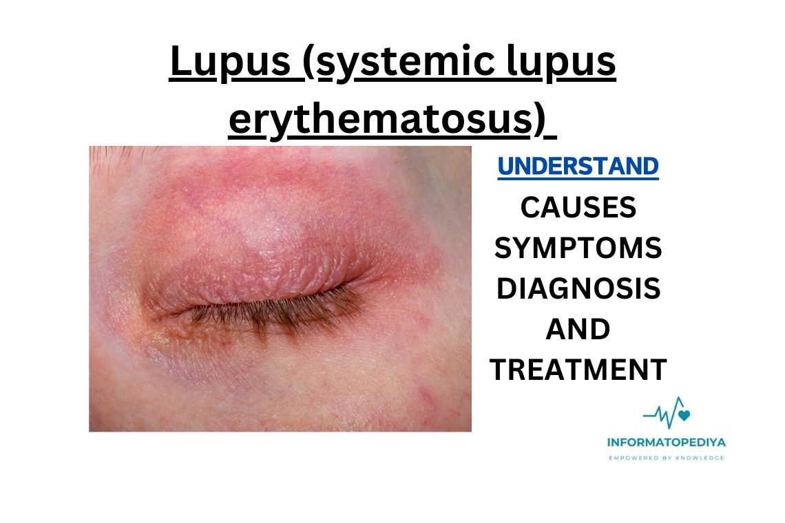 Lupus (systemic lupus erythematosus)